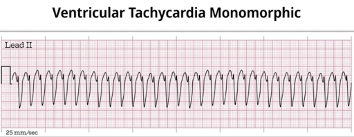 Ventricular Tachycardia Monomorphic