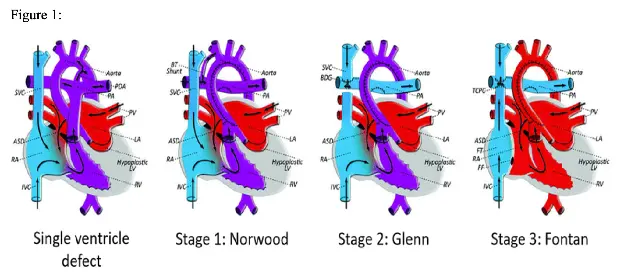 Figure 1: Diagram showing progression of single ventricle repairs from hypoplastic left heart through three surgical stages. The image illustrates the anatomical changes at each stage: native anatomy with hypoplastic left heart, Stage 1 with BT shunt and neoaorta creation, Stage 2 with superior cavopulmonary anastomosis, and Stage 3 with total cavopulmonary connection.